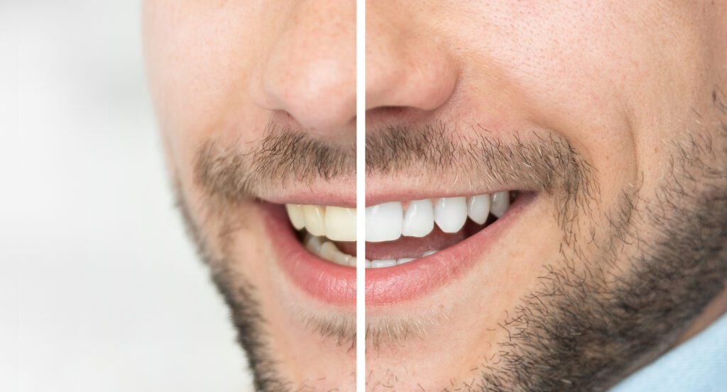 Teeth Whitening in Colmar, PA